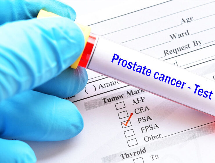 articulo_cancer-prostata